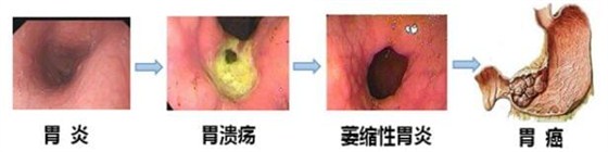 胃病的发展