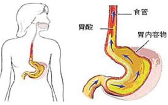 反酸0