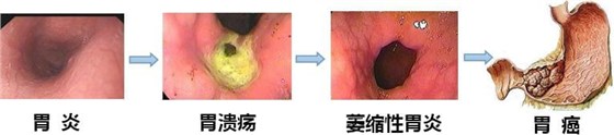 胃病变化