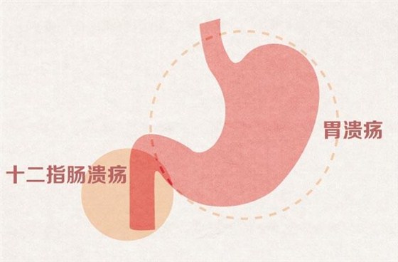 消化性溃疡