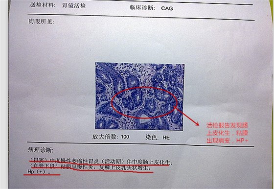 萎缩性胃炎2