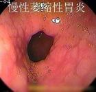 慢性萎缩性胃炎
