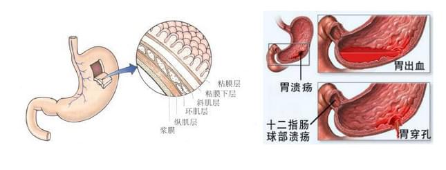 胃黏膜受损会出现的