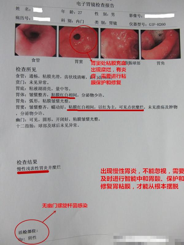 慢性胃炎报告