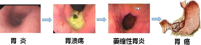 胃病变化