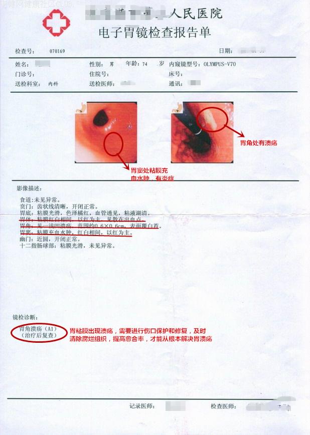 胃溃疡胃镜报告
