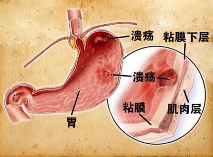 胃溃疡 胃糜烂0