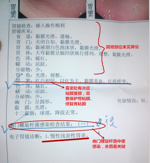 浅表性胃炎检验报告