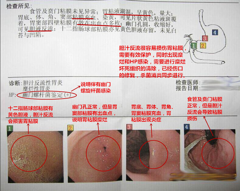 糜烂性胃炎胃镜报告