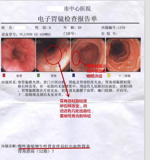 慢性萎缩性胃炎c2图片