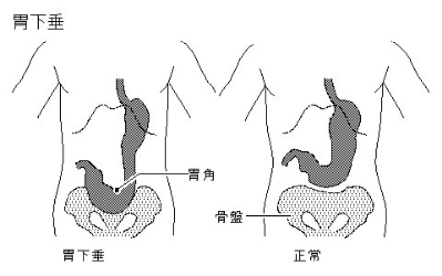 胃下垂