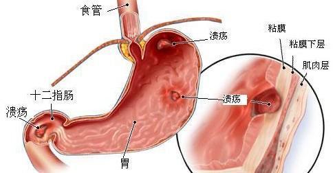 胃粘膜分层