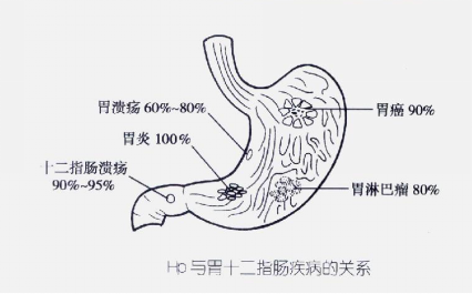 幽梦螺旋杆菌引发的问题